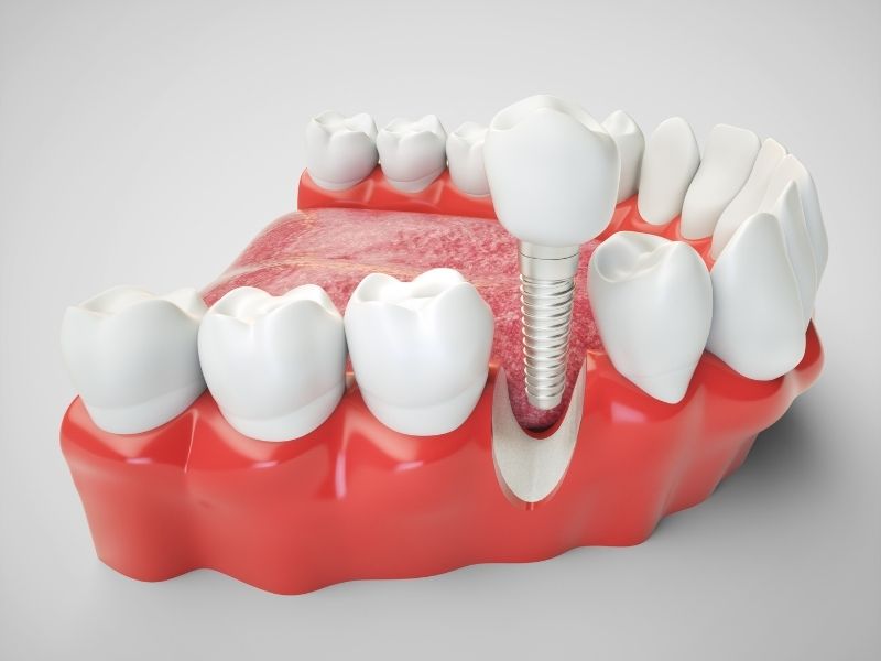 implant-tedavisi-avantajlari